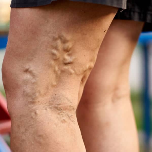 5 Best Exercises to Treat and Prevent Varicose Veins